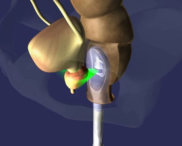 Ultraschallbehandlung der Prostata bei Prostatitis