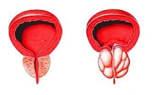 Prostata im Normalzustand (links) und durch Prostatitis entzündet (rechts)